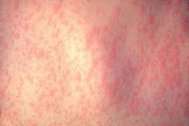 Measles; Measles in Africa; Measles in Nigeria; Outbreak of Measles 'Rubeola