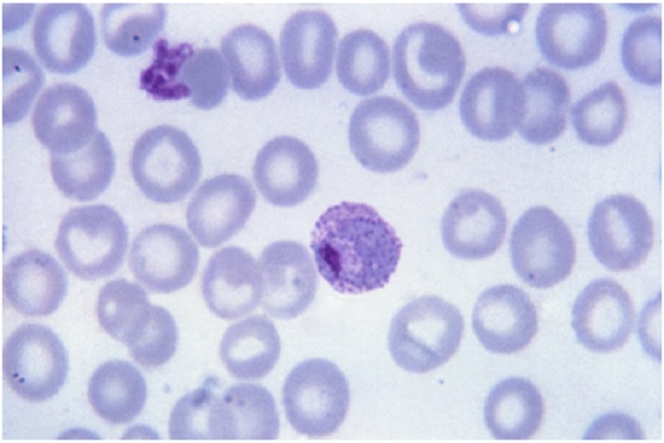 MALARIA: A COMPLETE OVERVIEW
