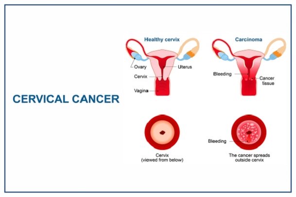 Women Cancer; Cervical Cancer: Cervical Cancer in Nigeria and Africa; Cervical Cancer Age Standardized Rate; What is Cancer of the Cervix?; Cancer of the cervix