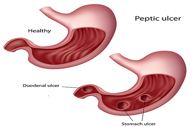 causes of stomach; how to prevent stomach ulcer; stomach ulcer; duodenum; gastric acid; gastric ulcer; peptic ulcer