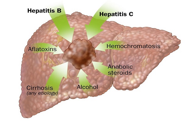 Liver Cancer; Causes of Liver Cancer; Hepatitis B, C and D; Cirrhosis