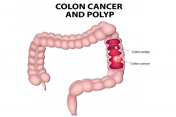 colorectal cancer, prevention of colorectal cancer, causes of colorectal cancer
