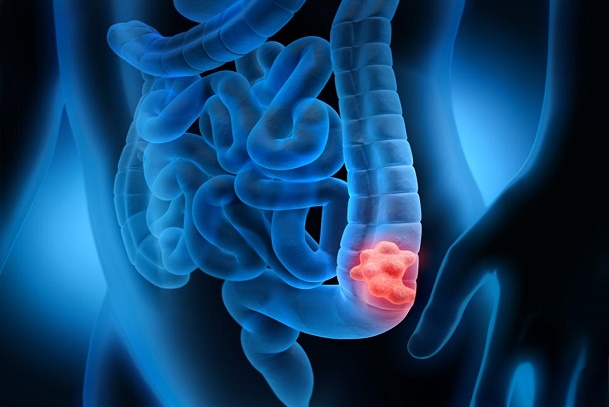 Colorectal cancer; colon cancer; rectum cancer; bone marrow