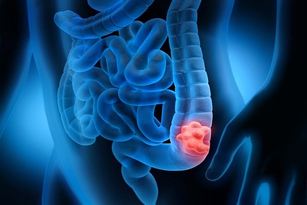 colorectal cancer; cancer in adults; colon cancer; rectum cancer; 4th most common cancer in the world; common cancer in nigeria