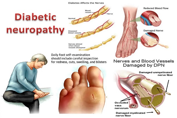 diabetes mellitus; type 1 and type 2 diabetes; diabetic neuropathy;complications of diabetes mellitus; symptoms of type 1 diabetes; clinical evaluation of type 2 diabetes; diagnostic evaluation of diabetes; how do diabete