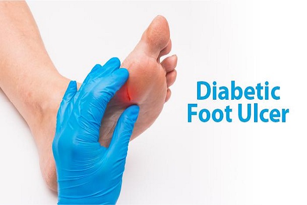 diabetes mellitus; type 1 and type 2 diabetes; diabetic foot ulcer;complications of diabetes mellitus; symptoms of type 1 diabetes; clinical evaluation of type 2 diabetes; diagnostic evaluation of diabetes; how do diabete