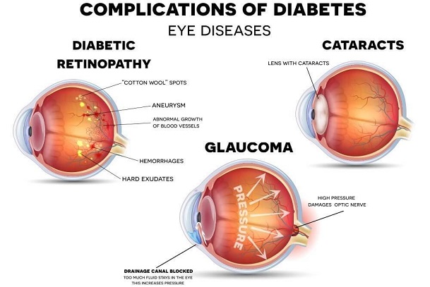 diabetes mellitus; type 1 and type 2 diabetes; eye damage; glaucoma; cataracts; diabetic retinopathy;complications of diabetes mellitus; symptoms of type 1 diabetes; clinical evaluation of type 2 diabetes; diagnostic evaluation of diabetes; how do diabete