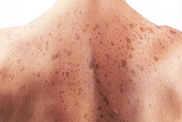 Skin cancer; How skin cancer manifest; signs and symptoms of skin cancer