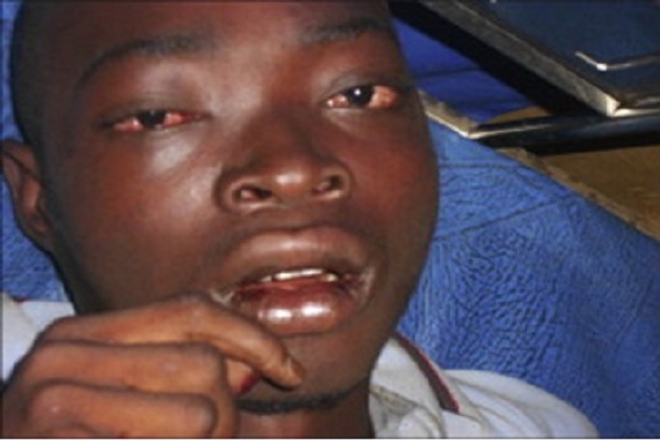 Lassa Fever Signs, Symptoms, and Challenges in Early Detection 