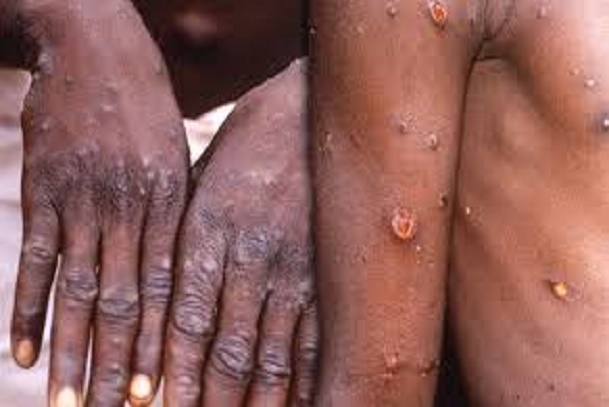 MonkeyPox; Outbreak of Monkeypox in Nigeria; Overview of Monkeypox