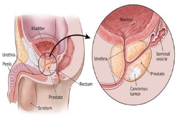 Prostate Cancer in Nigeria