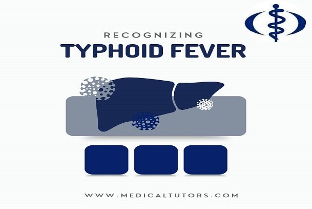Typhoid Fever Signs and Symptoms; Recognizing Typhoid Fever; When to see a doctor about typhoid fever