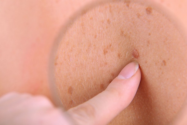 Skin cancer; what is skin cancer?; skin cancer in Nigeria