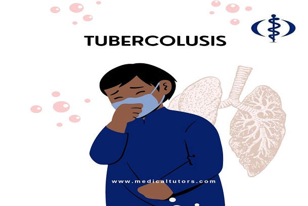 Tuberculosis; tuberculosis in Nigeria; what is tuberculosis?