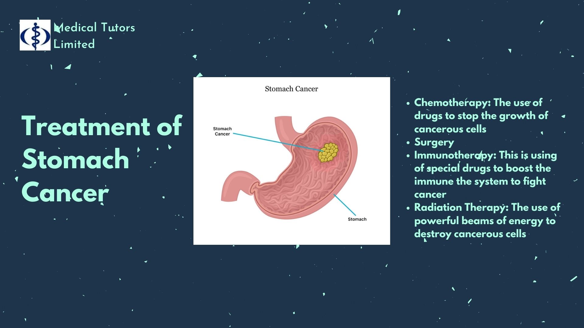 Treating Stomach Cancer; Stomach cancer; Treatment of stomach cancer; Is stomach cancer treatable?