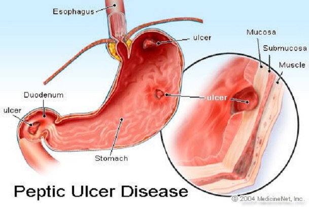 Stomach cancer versus stomach ulcer